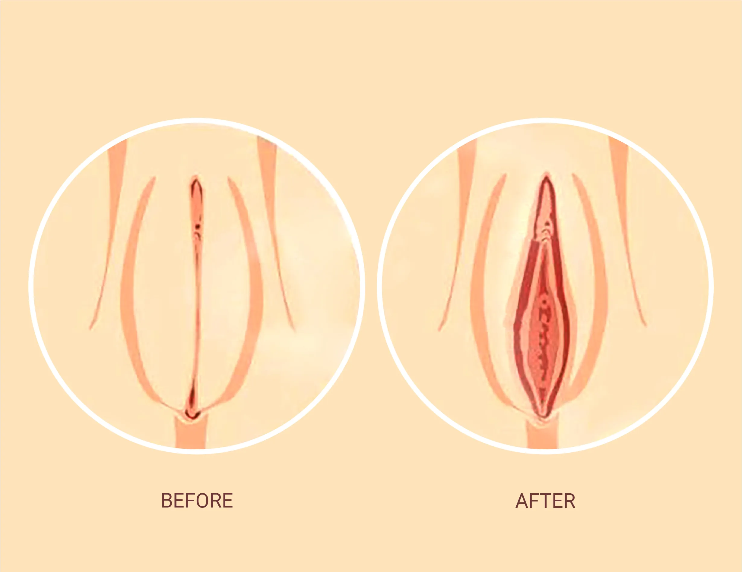 Labia majora augmentation