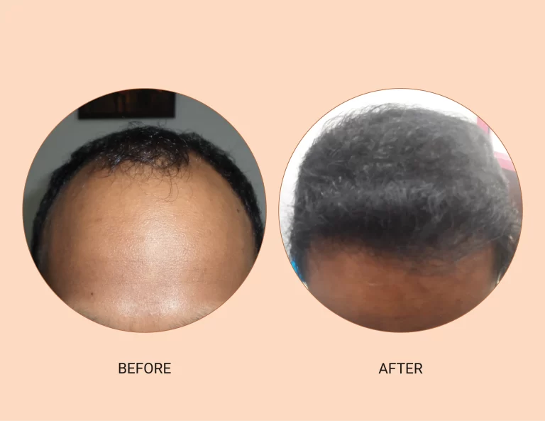 Exploring Different Hair Transplant Techniques, Which One Is Right for You?