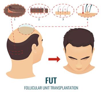 FUT-Hair-Transplant-1-copy