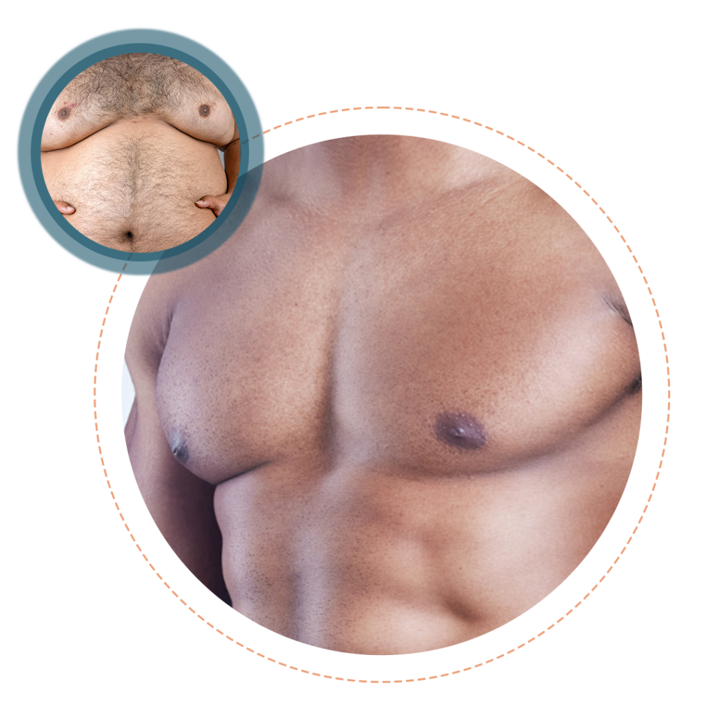 Ko_cosmetic _Gynecomastia