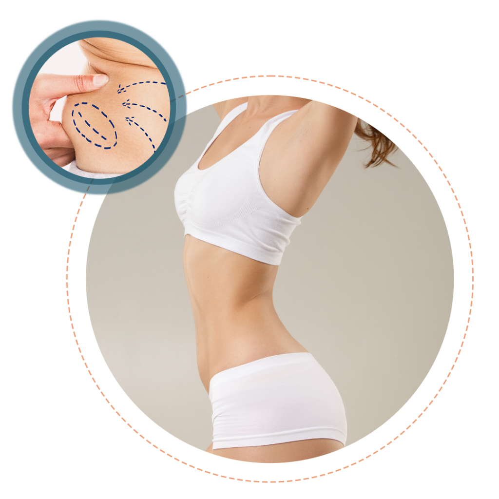 Liposuction