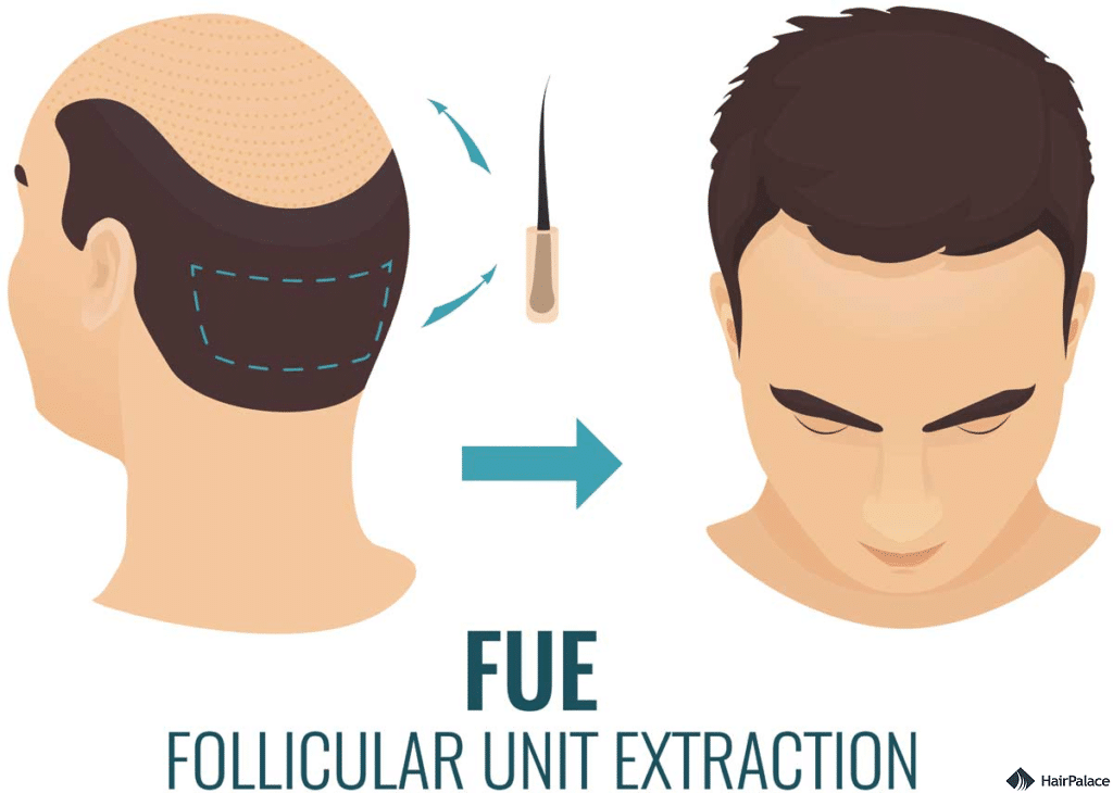 FUE-Hair-Transplant-1-copy