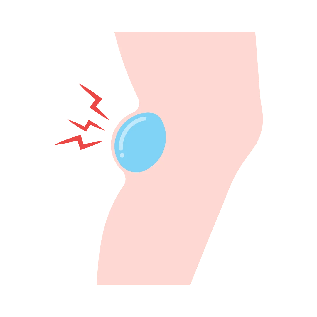 Multiple Lipoma Removal