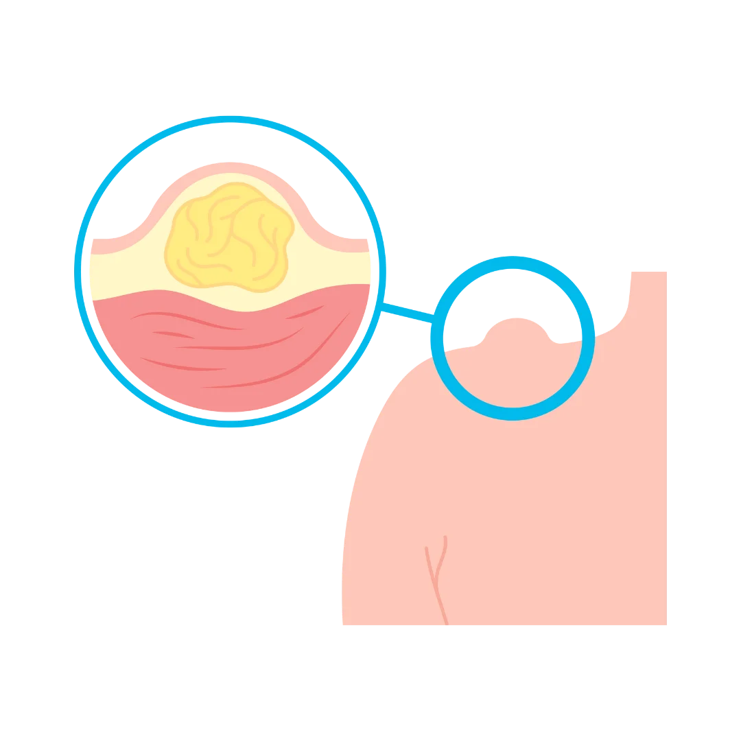 Multiple Lipoma Removal