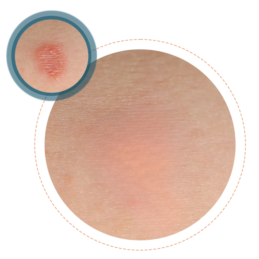 Hidradenitis Suppurativa