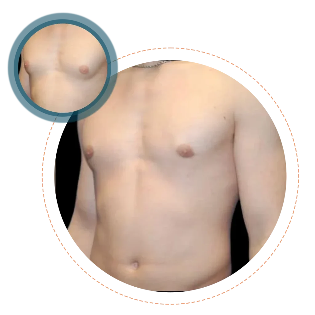 Male and Female Nipple Size Reduction