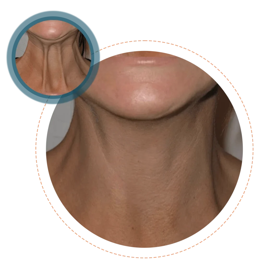 Platysma Band Correction