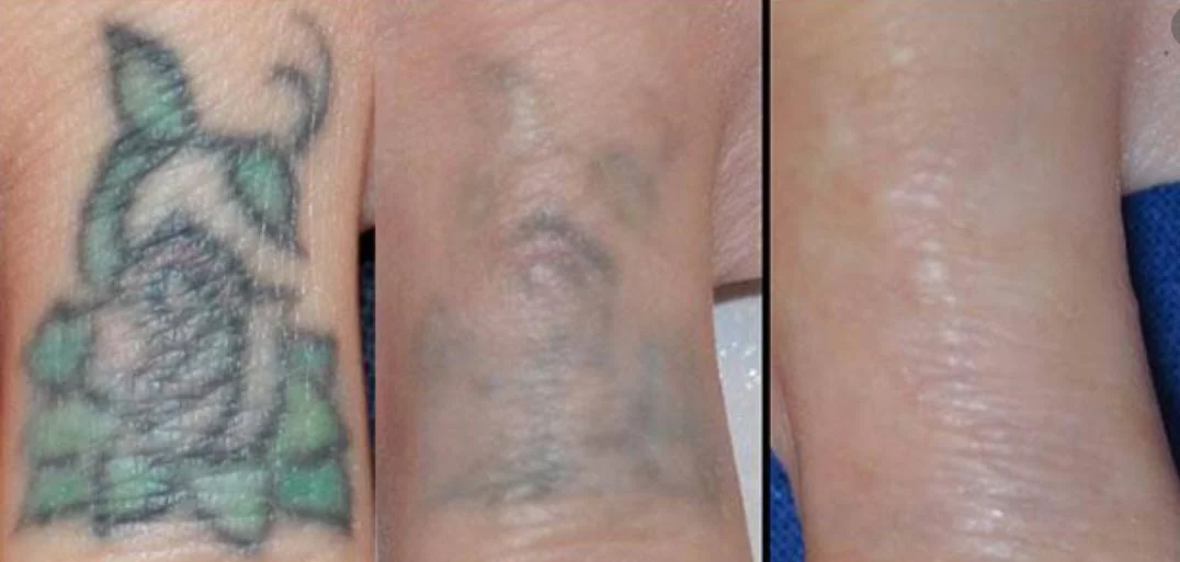 laser-tattoo-removal-mexico