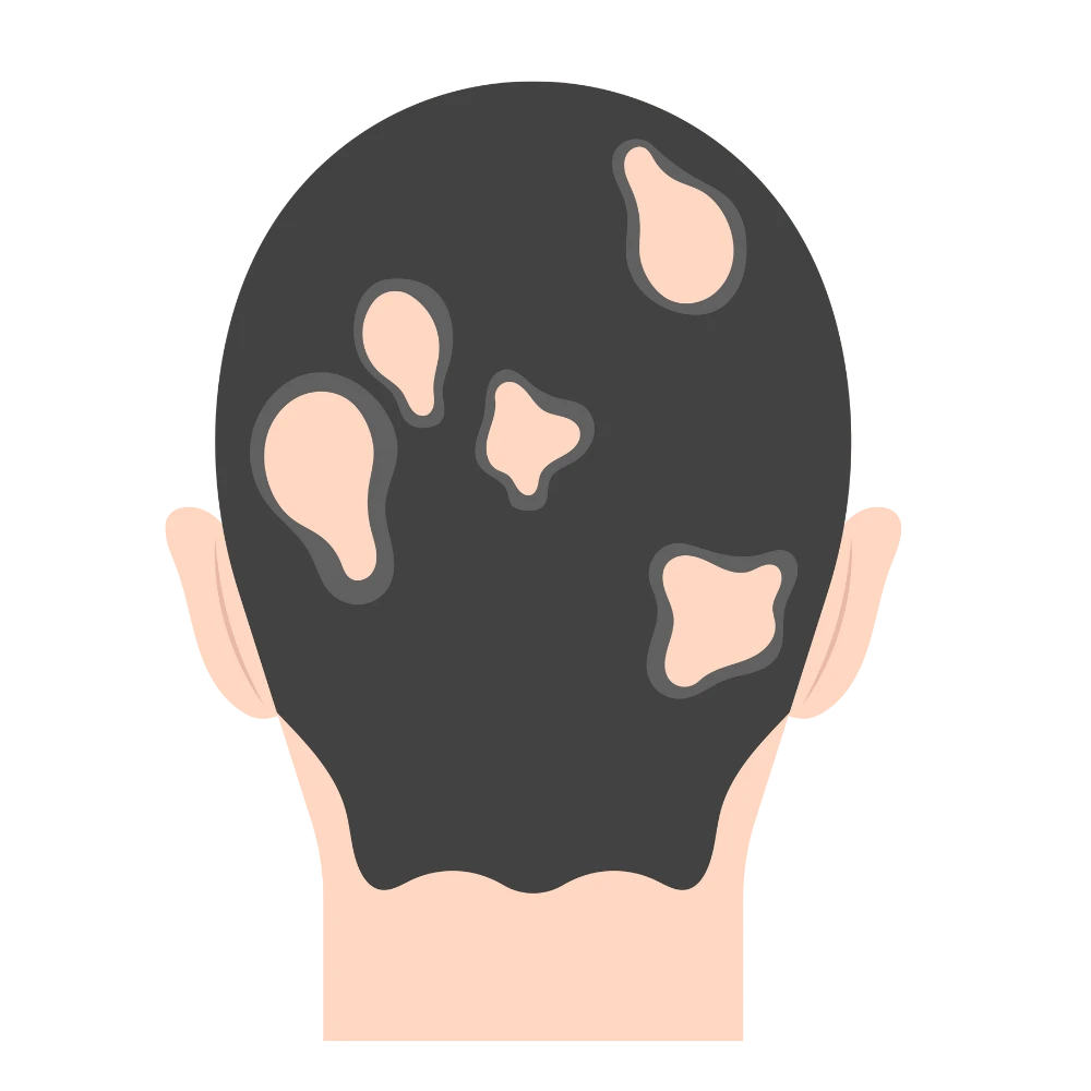 2.GFC Therapy for Bald Patches