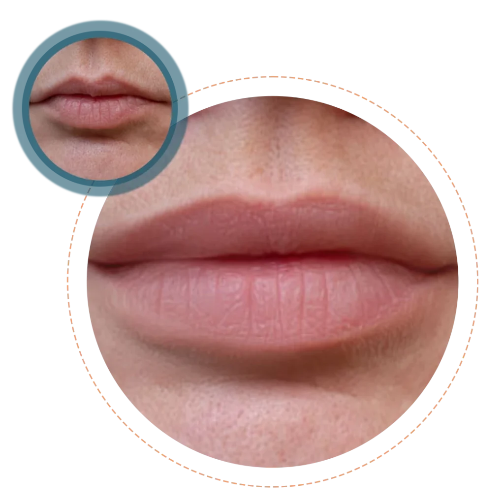 Lip Augmentation by Fillers