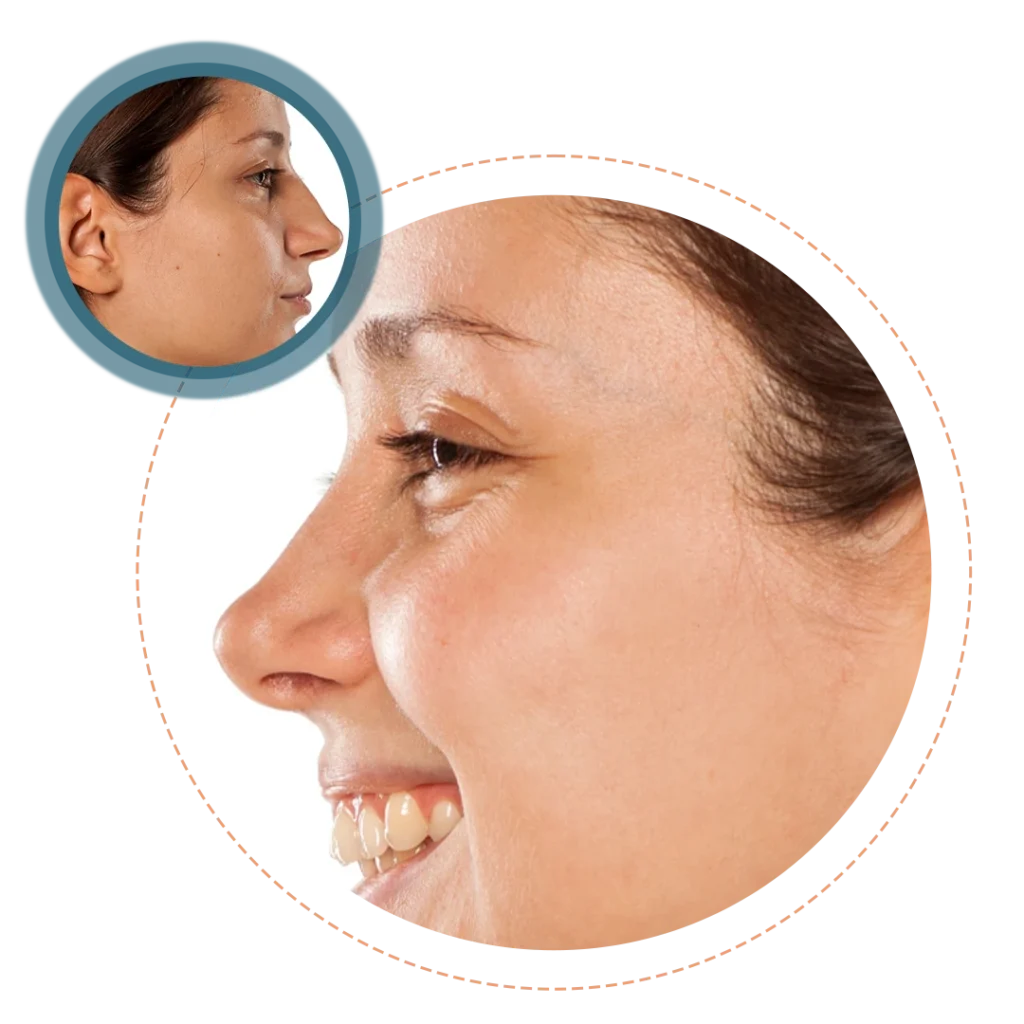 Rhinoplasty